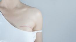 Tumori donne, in 10 anni +34% delle pazienti vive dopo la diagnosi