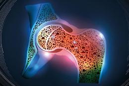 Osteoporosi, MOC: in viaggio all'interno delle ossa