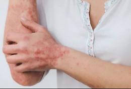 Psoriasi a placche, la Commissione europea approva  trattamento orale