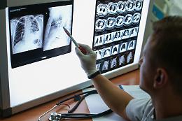 Tumore del polmone, -28% rischio morte con immunoterapia pre e post
