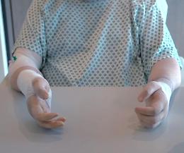 Reimpiantate le mani a un paziente vittima di doppia amputazione