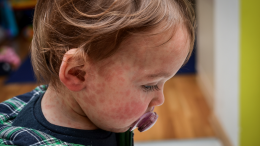 Morbillo, casi in aumento: la strada della prevenzione è la vaccinazione