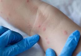 «Casi di scabbia». Genitori subito allertati