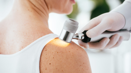 Melanoma, 2024 anno ‘nero’: +30% di diagnosi. Cresce l’immunoterapia
