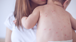 Morbillo, aumento dei casi in Italia: il 90% non era vaccinato