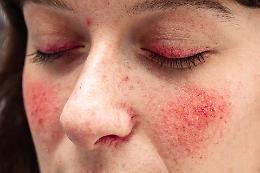 Psoriasi oculare: cause, sintomi e trattamenti per proteggere gli occhi