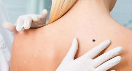 Con la Lilt l'ambulatorio anti melanoma