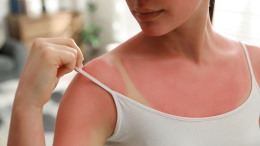Scottature da ragazzi, rischio melanoma da adulti: l’allarme che nessuno può ignorare