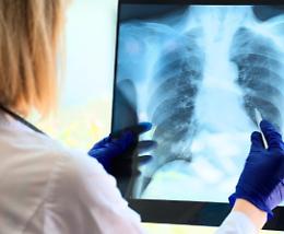 Tumore al polmone, uno screening salvavita