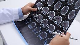 Cervello e sistema immunitario: scoperto un nuovo collegamento nella sclerosi multipla