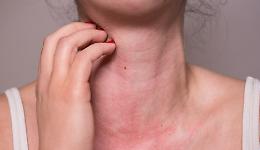 Gravi allergie, arriva lo spray nasale: alternativa semplice all’iniezione salvavita