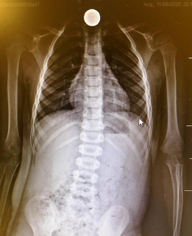 Bimbo di tre anni ingerisce una moneta, operato e salvato al Maggiore