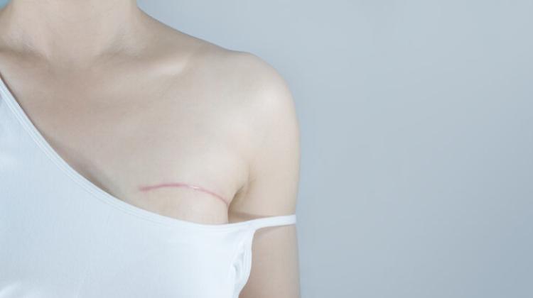 Tumori donne, in 10 anni +34% delle pazienti vive dopo la diagnosi