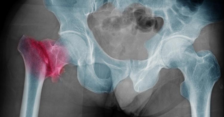 Osteoporosi, malattia silenziosa che colpisce le ossa