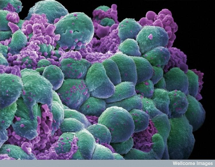 In aumento le diagnosi di tumore, è allarme per gli stili di vita