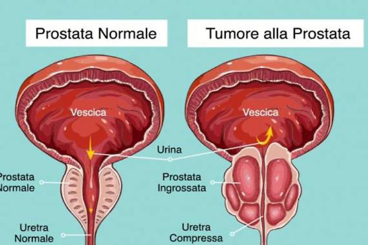 Tumore prostata, per molti pazienti basta monitoraggio attivo
